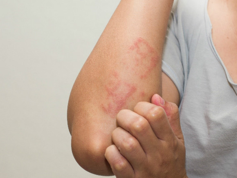 Is The Urticaria Caused By Helminth Infection? How To Identify And Handle How?