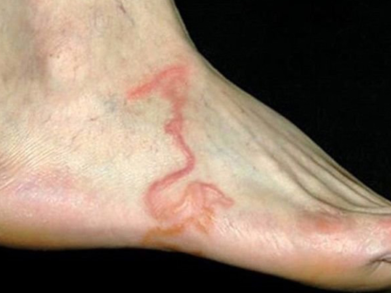 What Are The Signs Of Atopic Dermatitis In Blood?