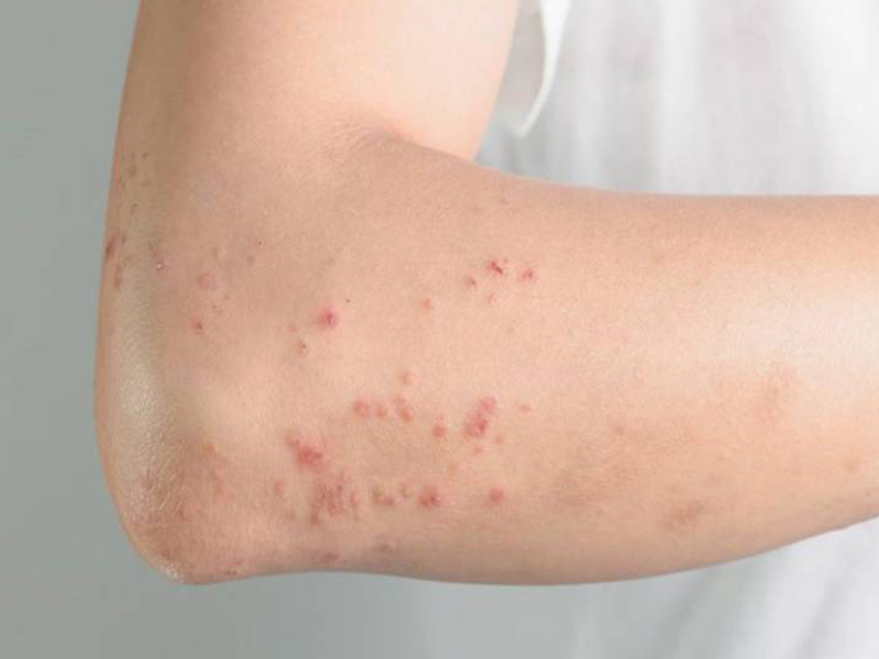 Signs Of Itchy Rash Due To Infection With Worms In Blood