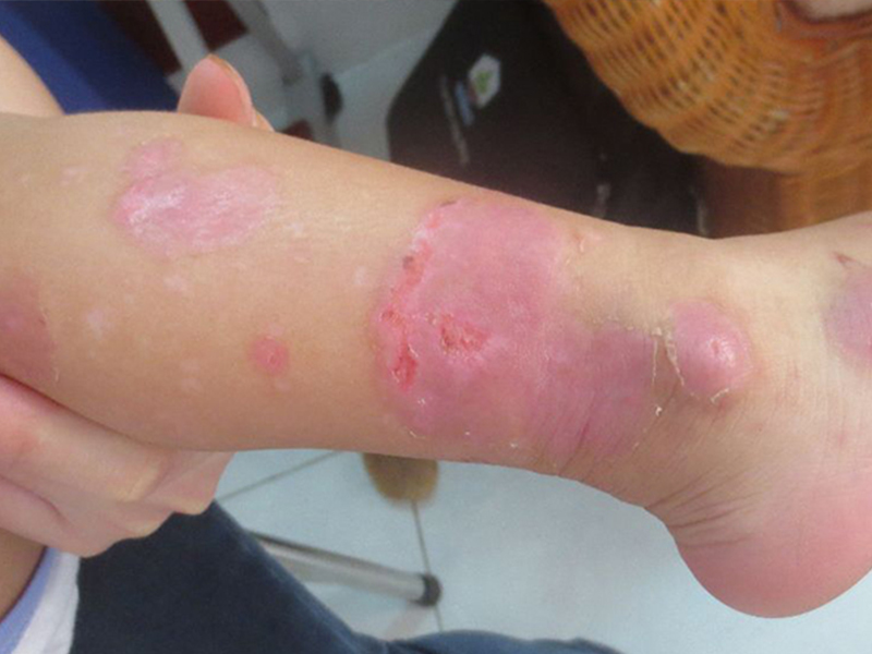 Itchy Skin Rashes Are Caused By Helminth Infections