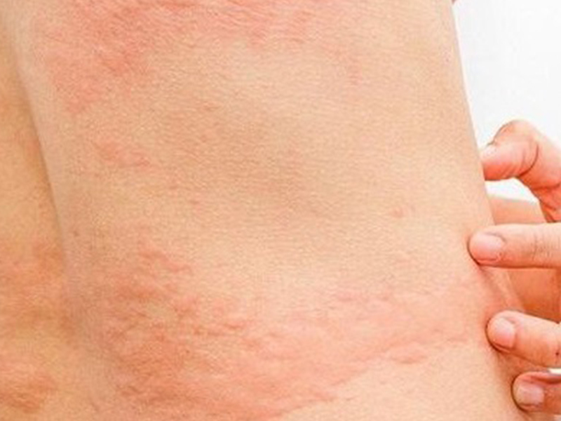 Stinging Under The Skin Is What Disease?