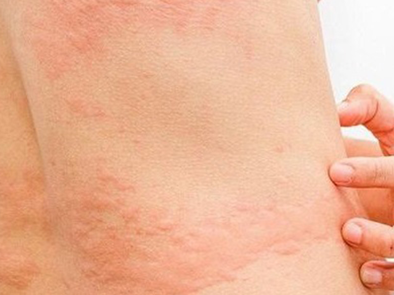 Harm When Infected With Paragonimus Lung Fluke Harm When Infected With Paragonimus Lung Fluke