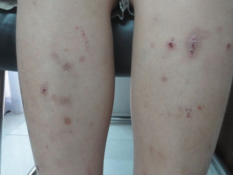 Itchy Skin Irritation Due To Infection With Helminth Parasites In The Blood